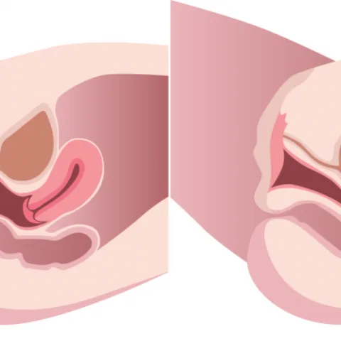 Aralığın bərpası (Perineoplastika)