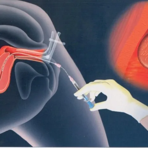 Aşılama – Uşaqlıqdaxili inseminasiya