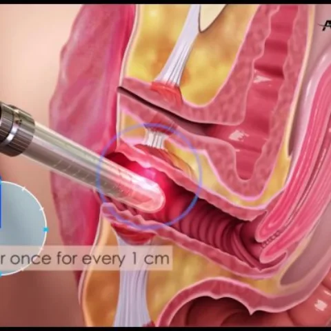 Düz bağırsaq sallanmasının (rektoselin) vaginal üsulla müalicəsi