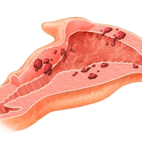 Laparoskopik Endometrioz Cərrahiyyəsi
