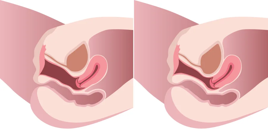 Aralığın bərpası (Perineoplastika)