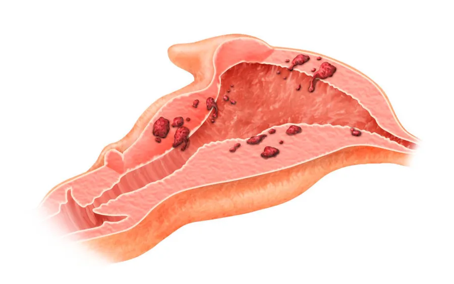 Laparoskopik Endometrioz Cərrahiyyəsi